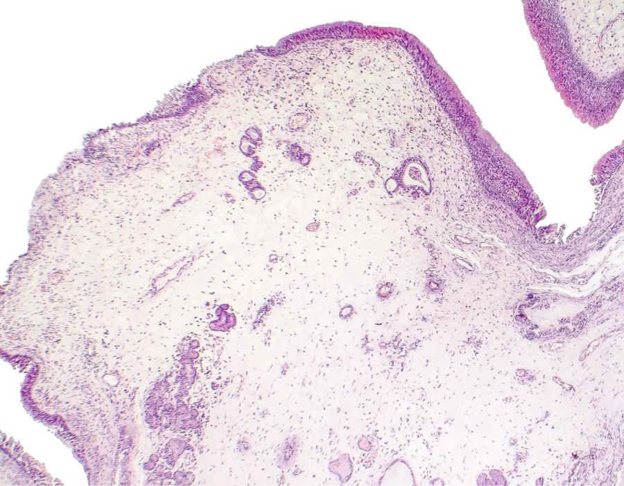 Hyperplastic polyps and inflammatory polyps