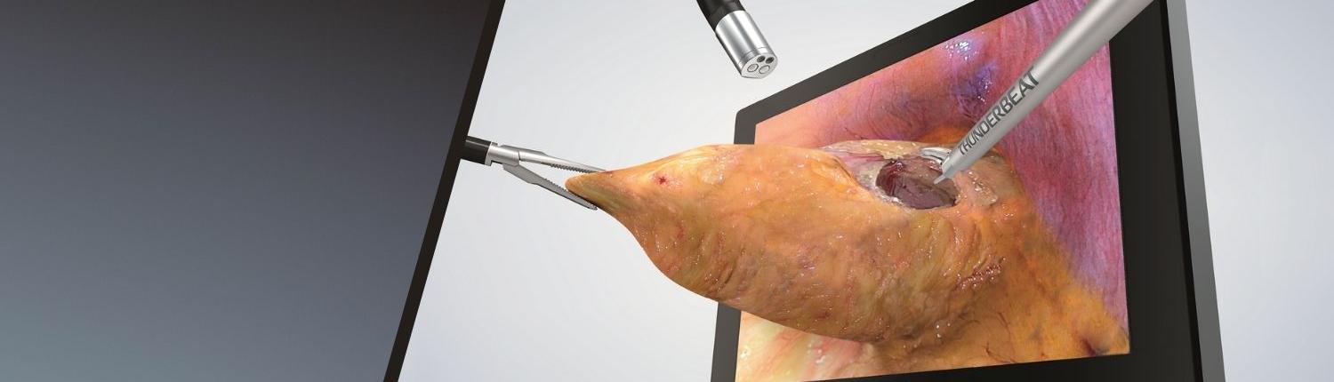 3D Laparoscopic Surgery