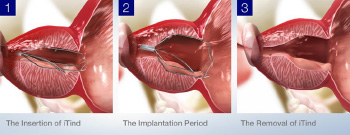 iTind Procedure