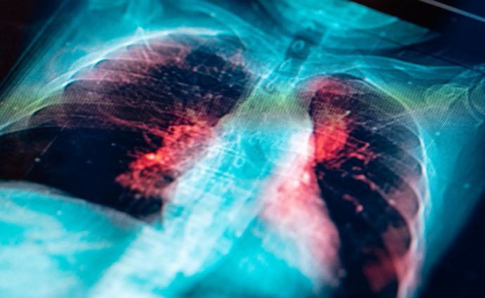 lung cancer screening